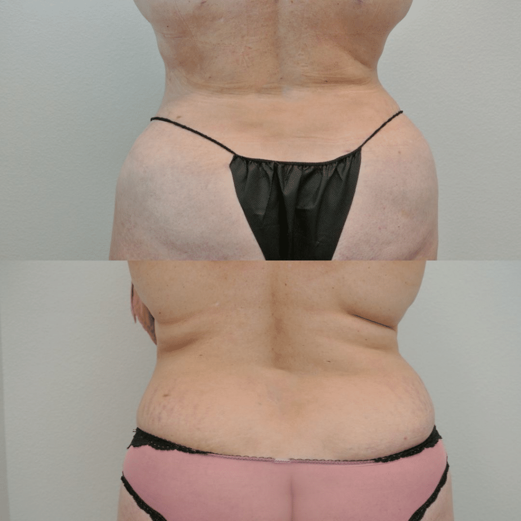 Before and after body contouring showing reduced waist and improved back shape.